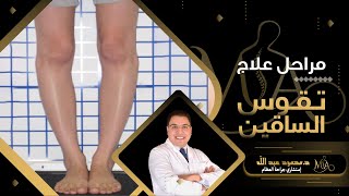مراحل علاج تقوس الساقين في البالغين| Bow leg| دكتورمحمود عبدالله