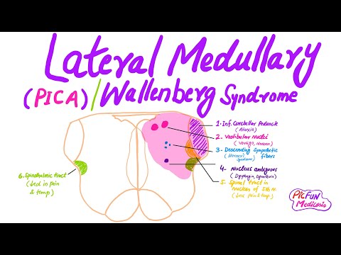 Wallenberg syndrome,PICA,Lateral Medullary syndrome,USMLE