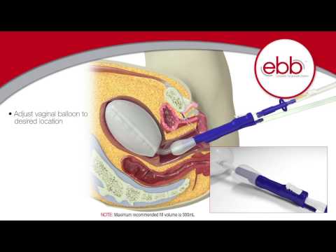 Istruzioni per ebb® Tamponade System per il trattamento dell&rsquo;emorragia postpartum