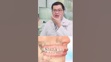 Niềng răng có xấu không? Giai đoạn nào là xấu nhất nhỉ 🤔