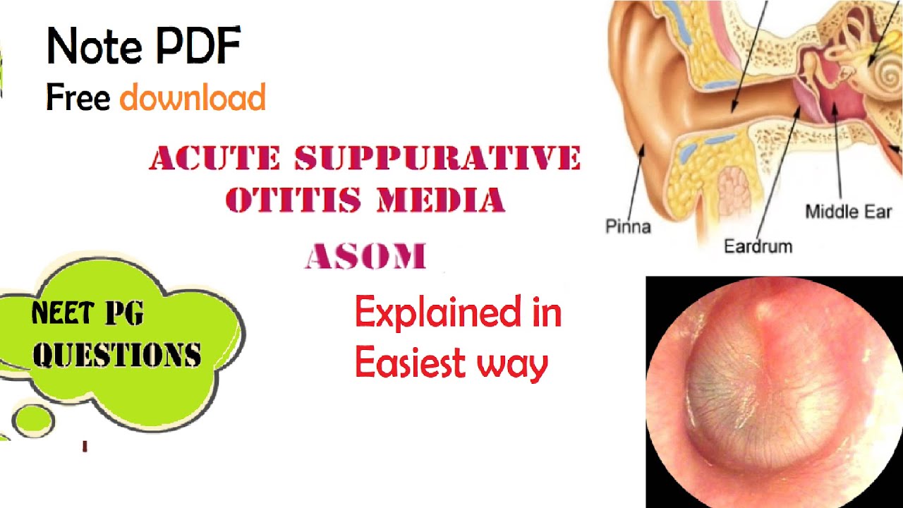 Acute Suppurative Otitis Media Asom Ent Easy Explanation Stages