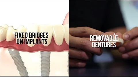 Dr. Simon Oh Explains the Difference Between Dental Implants & Dentures