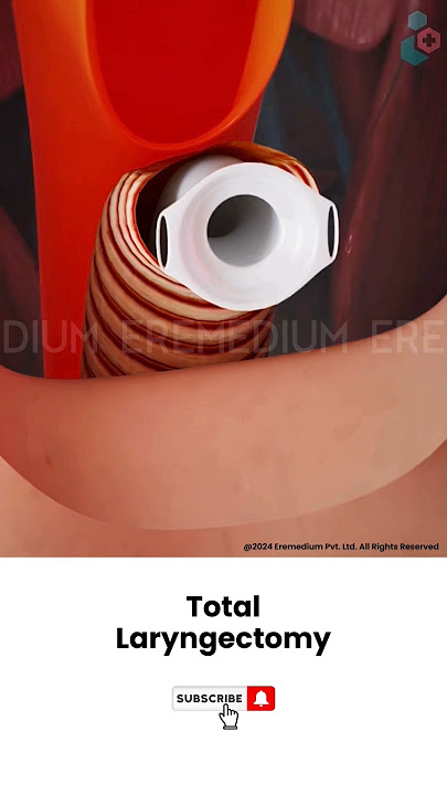 Laryngectomy: Throat Cancer Surgery ↪ 3D Medical Animation #Shorts #Laryngectomy #Throat #Surgery