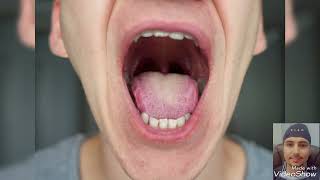 tonsillitis vs toothache | التهاب اللوزتين والم الاسنان