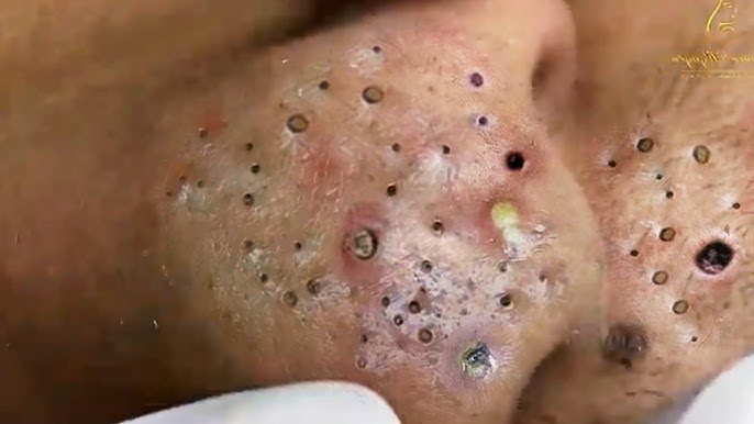 Big Cystic Acne Blackheads Extraction Blackheads & Milia, Whiteheads  Removal Pimple Popping # 3796 - YouTube