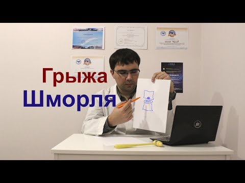 Грыжа Шморля: причины, симптомы, лечение