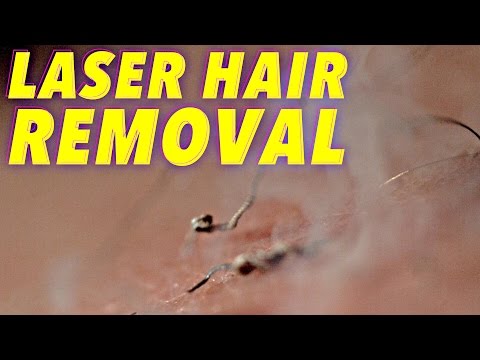 Science of Laser Hair Removal in SLOW MOTION