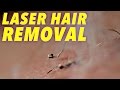 Science of Laser Hair Removal in SLOW MOTION