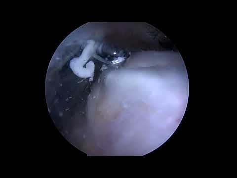 Shoulder Arthroscopy for Calcific Tendinitis