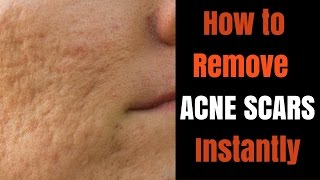 Instant acne scar removal