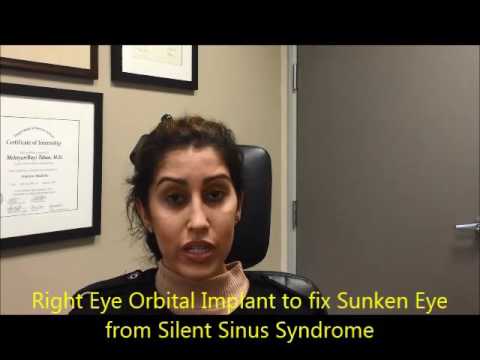 Eye Trauma Fracture Orbital Blow Out Treatment Beverly Hills