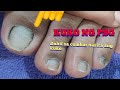 Most satisfying Ingrown toenail removal on the enternet..