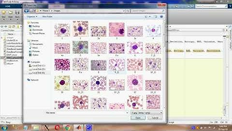 Skin Cancer, MATLAB, SVM, MultiSVM, Cancer Cell Classification, K-Means, NN