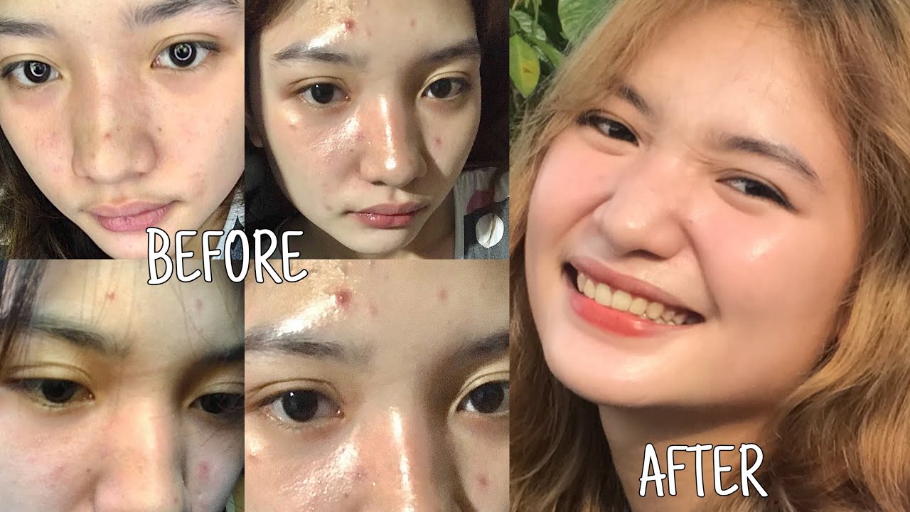 SKINCARE ROUTINE 2020 HOW TO REMOVE ACNE AND ACNE SCARS YouTube