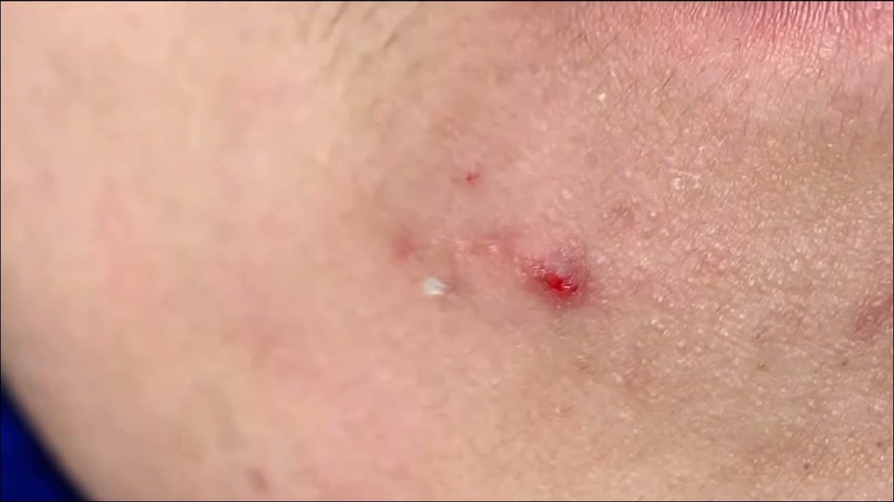 BEST ACNE VIDEO BLACKHEADS AROUND THE LIPS YouTube