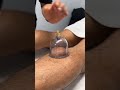 Foot Cupping For Runners!