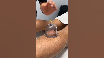 Foot Cupping For Runners 