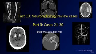Fast 10: Neuroradiology high speed case review part 3 - Cases 21-30