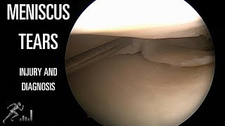 Meniscus Tear Mechanism Of Knee Injury And Diagnosis