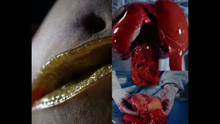 Weight Loss Journey - I Narrowly Escaped Death