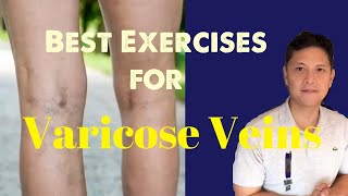 Best Exercises for Varicose Veins:Gawin ito para ma prevent o mabawasan ang Varicose Veins.