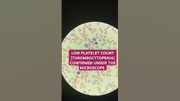 Thrombocytopenia, low platelet, confirmed under the microscope #thrombocytopenia #plateletcount