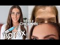 2 weeks after botox  daily updates  results  fixing spock eyebrows  botox before and after