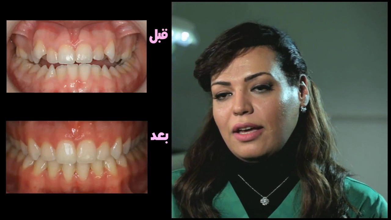 اضرار عدسات الاسنان