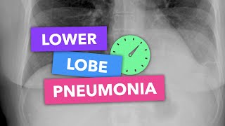Lower lobe pneumonia - Radiopaedia's Emergency Radiology Course screenshot 5