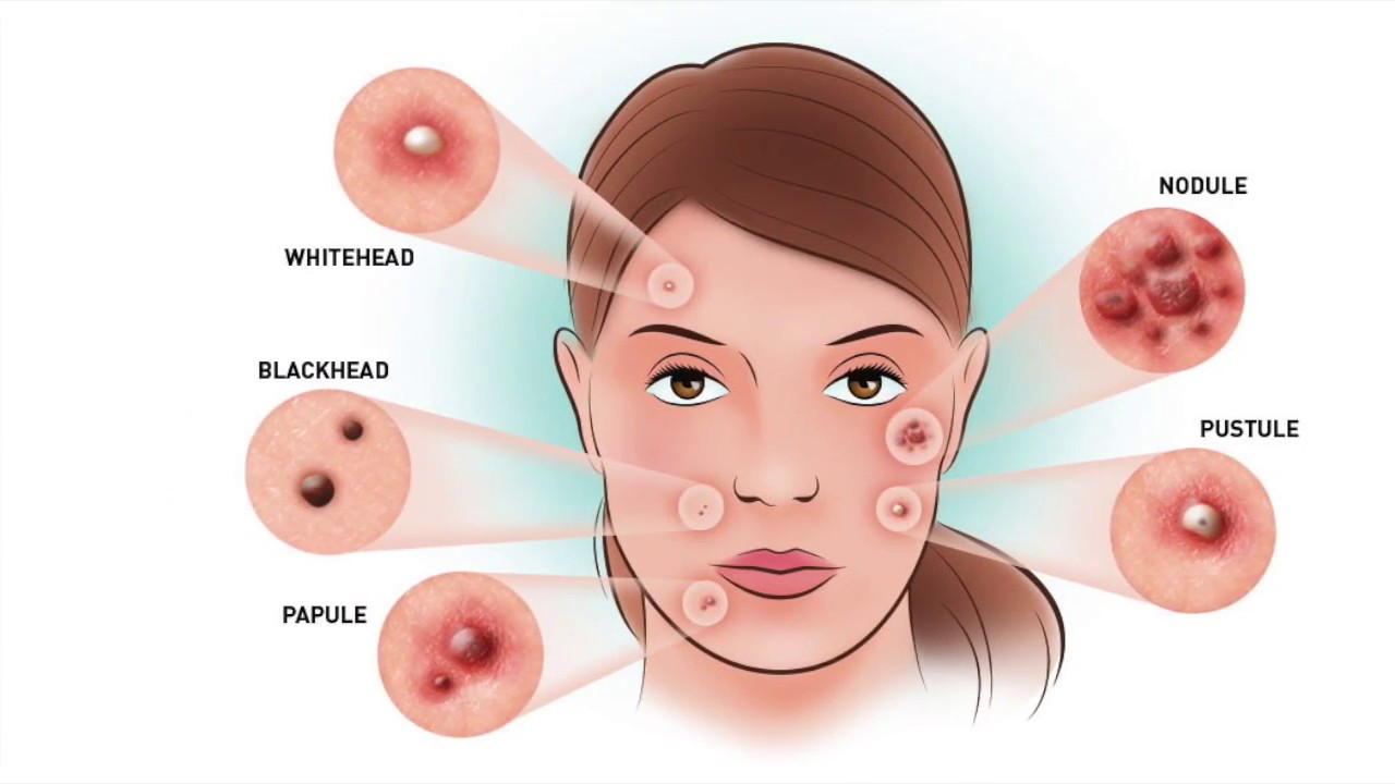 6 Different Types Of Pimples That You Should Know - YouTube