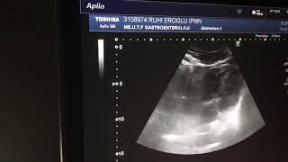 Prof.dr. Orhan Sezginden Kalbin Ultrasonografik Görünümü , Vena Cava Inferiorun Karaciğere Girmesi