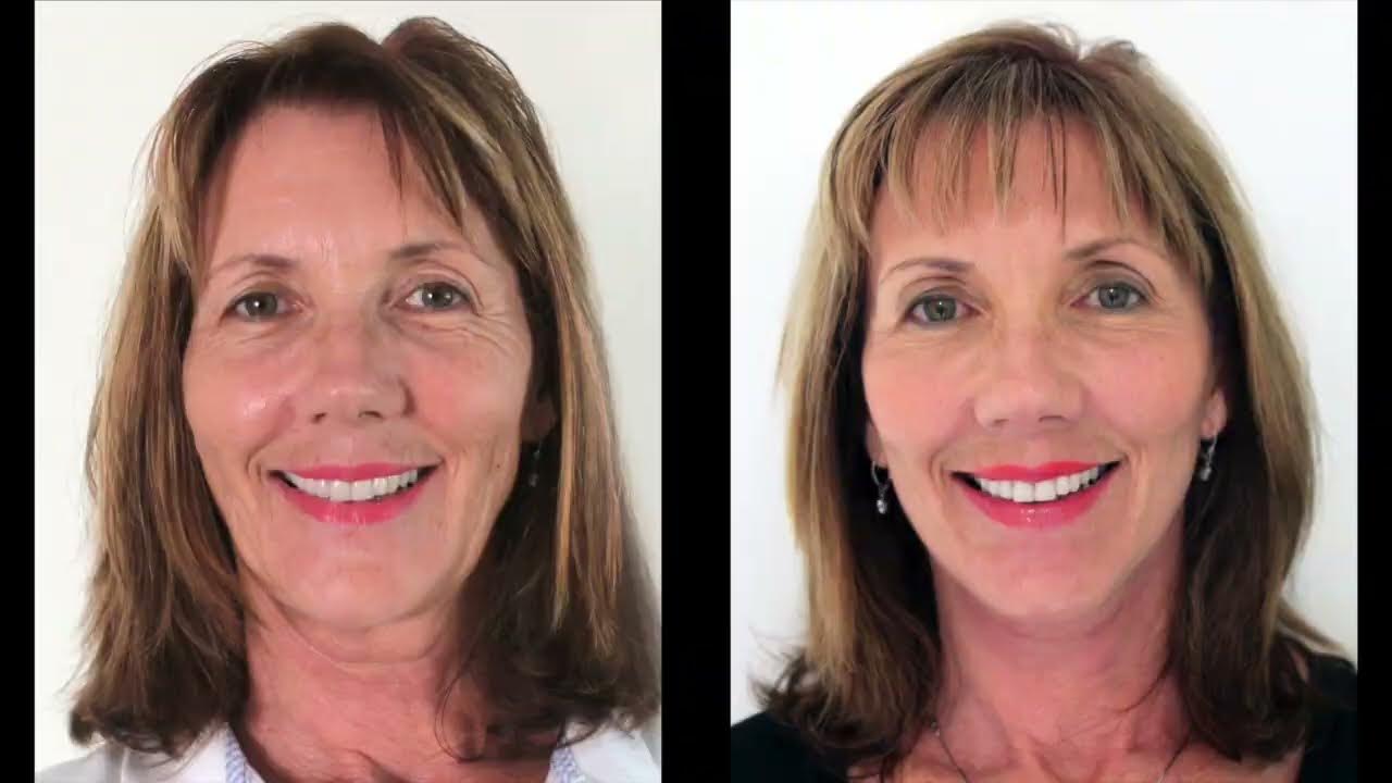 Facelift Surgery Before and After Photos Specialist Plastic Surgeon Dr David Sharp in Brisbane
