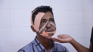 Face Reconstruction After Oral Cancer Surgery