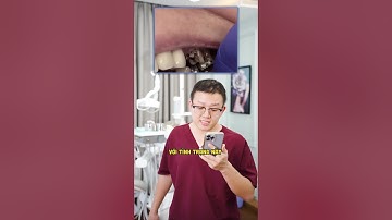 Hỏng chân răng trụ, của cầu răng sứ thì phải làm sao?