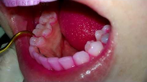 Biofilmindexberekening