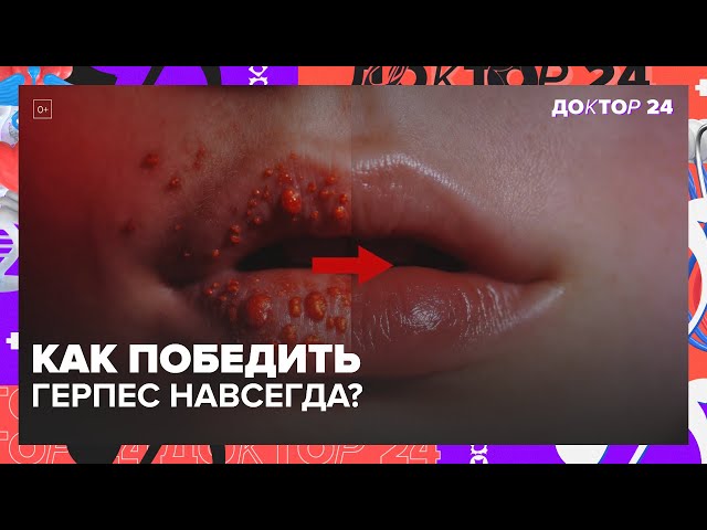 Почему появляется герпес на губах и как его лечить | Доктор 24