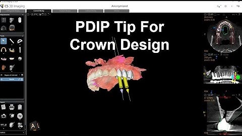 CS 3D Imaging and PDIP Crown Designing Tip