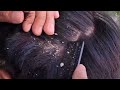 ASMR Scalp Scratching for Sleep and Relaxing Care #573