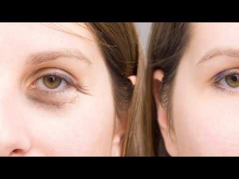 فيلر طبيعي من المنزل لعلاج التجاويف والانتفاخات حول العين وصفه طبيعيه ممتازه لازم تجربوها