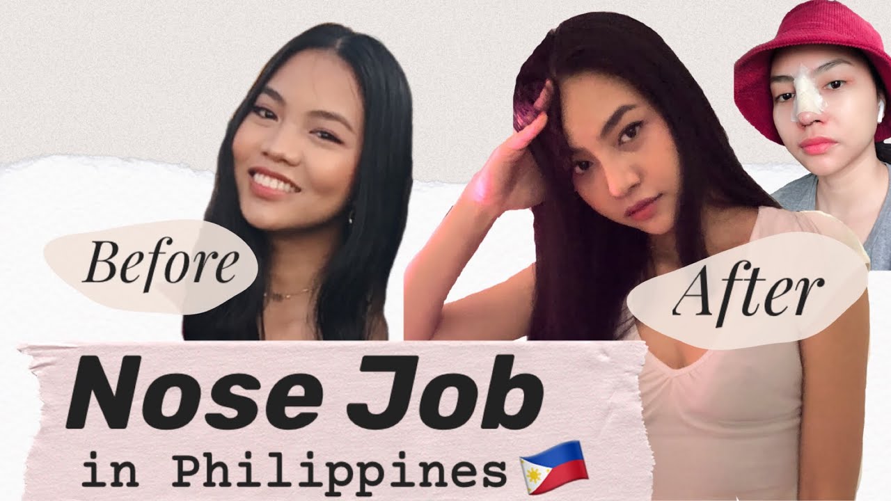 My Rhinoplasty Journey - Post-op nose reveal (Philippines) + some reactions from my family