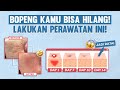 Atasi Bekas Jerawat Tidak Rata, Kulit Mulus Merona Kembali