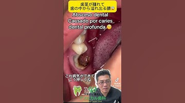 歯茎が腫れて歯の中から溢れ出る膿😱