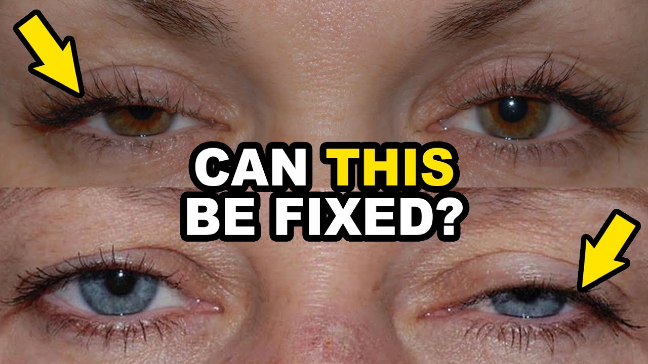 Can Eyelid Surgery CORRECT Ptosis? Plastic Surgeon Answers YouTube