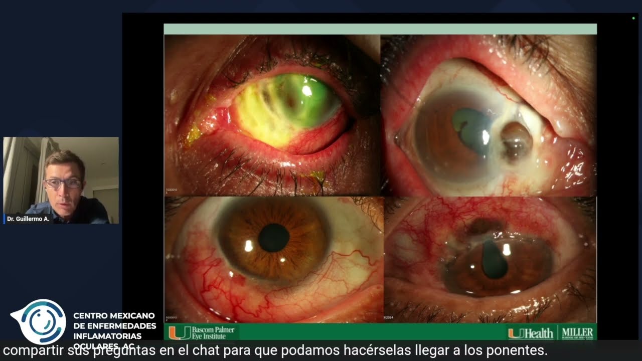 Infectious Scleritis