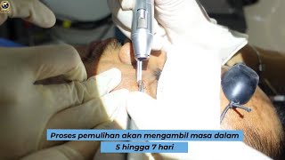 Proses Membuang Tahi Lalat: Laser Mole Remover | Glojas Aesthetic Clinic