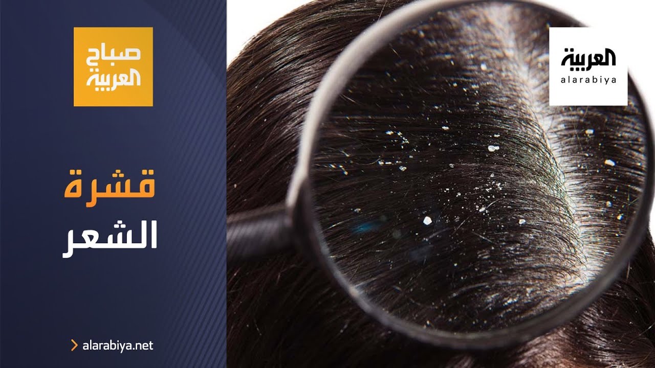 صباح العربية | كيف نتخلص من قشرة الشعر؟