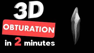 3D OBTURATION | Guttaflow obturation