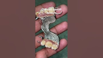 Old cast partial denture 😬😬😬#apexdental #partialdenture #splittooth #orthodontist #dentistry