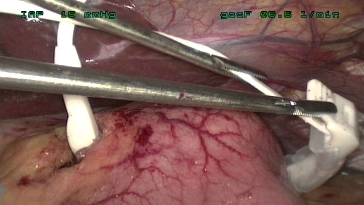 Magenband: Adipositas-Chirurgie