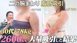 【上腕全周・脇肉 脂肪吸引】BMI32 脂肪吸引して3ヶ月後…のサムネイル